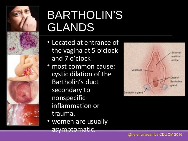 infected gland in vagina Infected gland in vagina